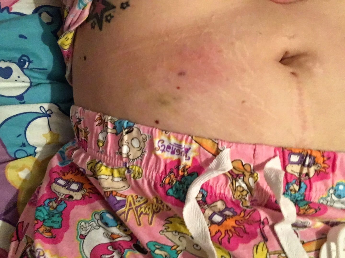 stomach-bruising-after-clexane-injections